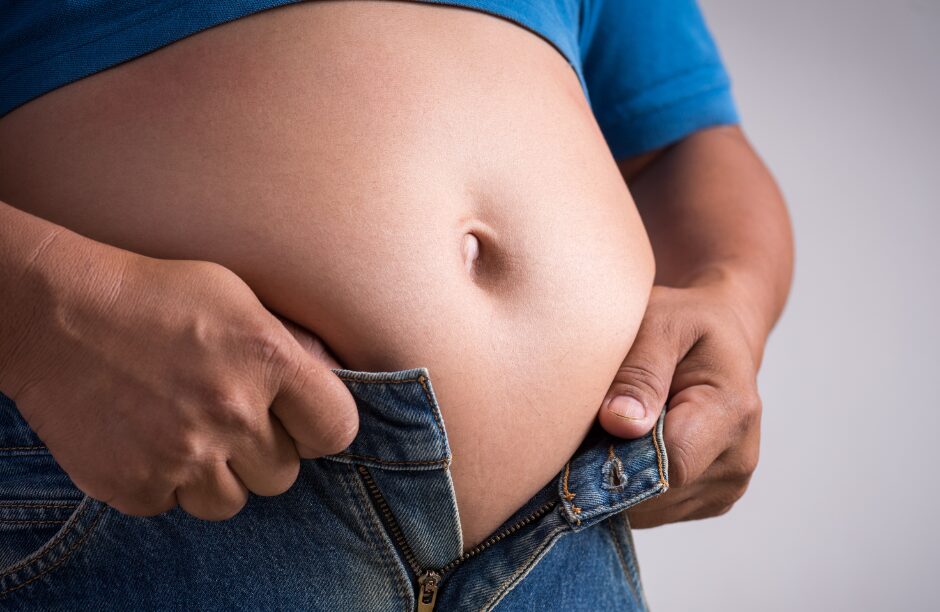 Paciente com Obesidade com dificuldade para fechar a calça.